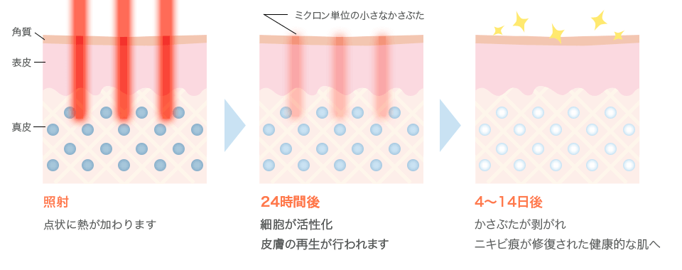 CO2フラクショナルレーザーの仕組み