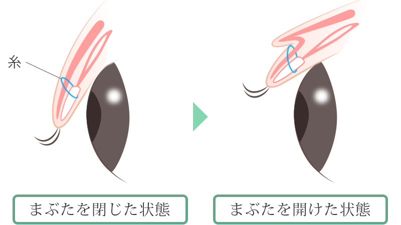 横須賀ローズマリークリニックの埋没法のメカニズム