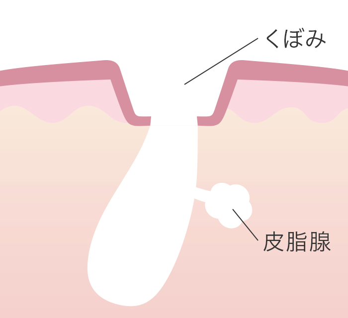 クレーター(ニキビ跡)