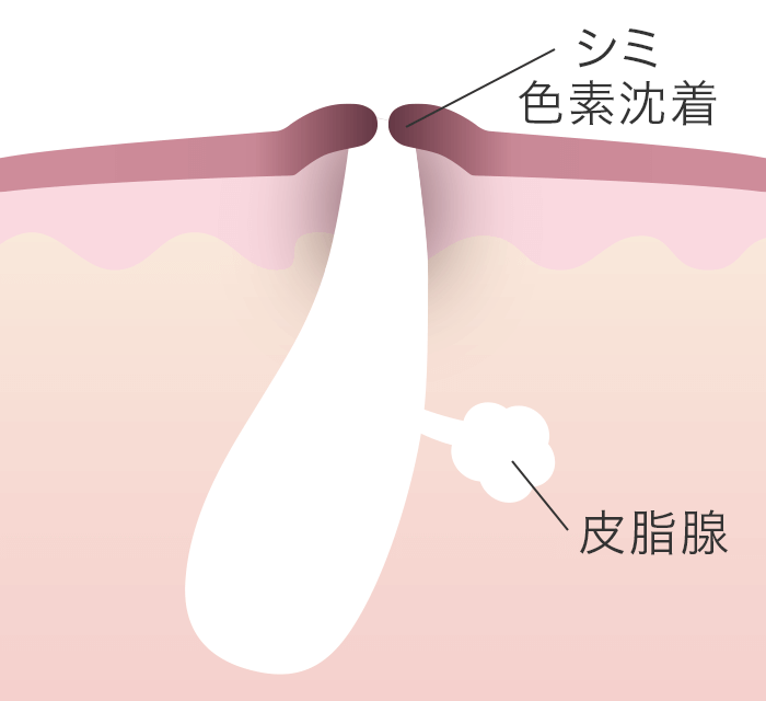 色素沈着(ニキビ跡)
