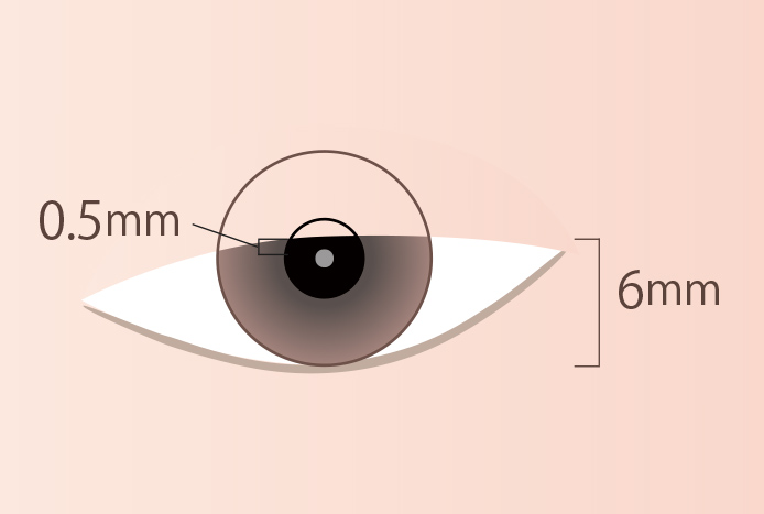 中程度の眼瞼下垂