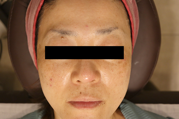 頬のシミ取り症例1（日光性黒子・老人性色素斑） レーザートーニング6回終了時1