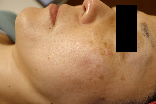 頬のシミ取り症例1（日光性黒子・老人性色素斑） レーザートーニング6回終了時1