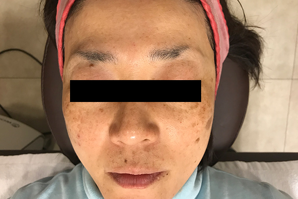 頬のシミ取り症例1（日光性黒子・老人性色素斑） 治療前3
