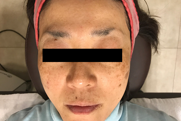 頬のシミ取り症例1(日光性黒子・老人性色素斑) 治療前3