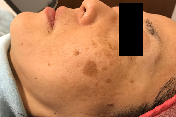頬のシミ取り症例1（日光性黒子・老人性色素斑） 治療前1