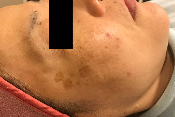 頬のシミ取り症例1（日光性黒子・老人性色素斑） 治療前2
