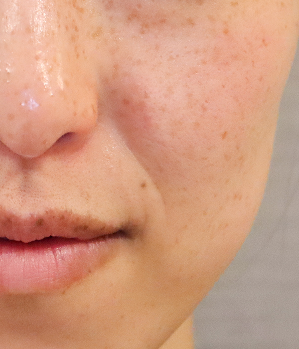 頬のシミ取り症例2（日光性黒子・老人性色素斑） 7回目