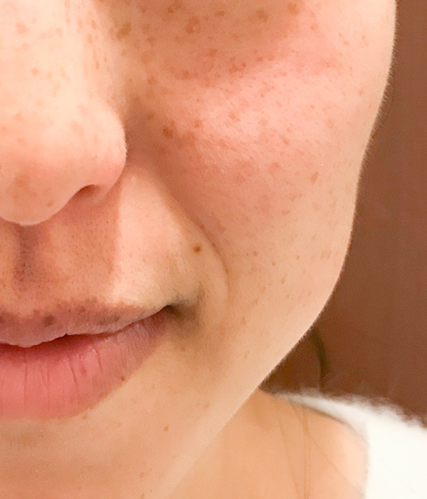 頬のシミ取り症例2（日光性黒子・老人性色素斑） 施術前