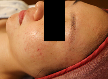 ケミカルピーリングの症例写真（おでこ・左頬）施術後