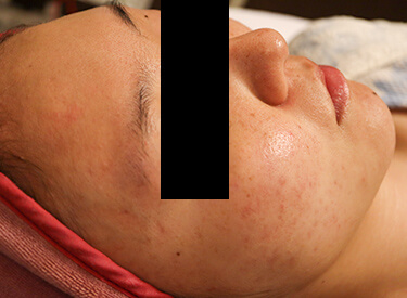 ニキビ治療の症例写真（生え際・右頬）施術後
