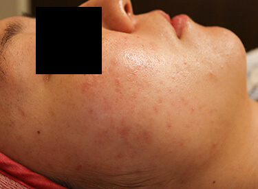 ニキビ治療の症例写真（右頬・フェイスライン・あご）施術後